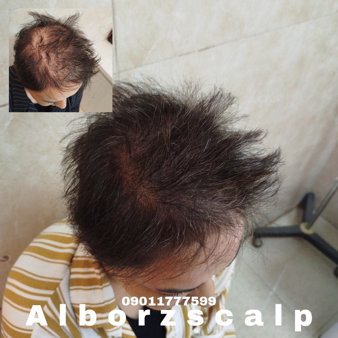 اسکالپ پوششی